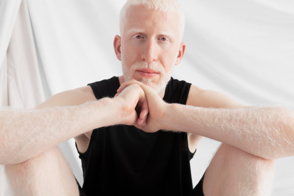 Mitos y verdades sobre el albinismo